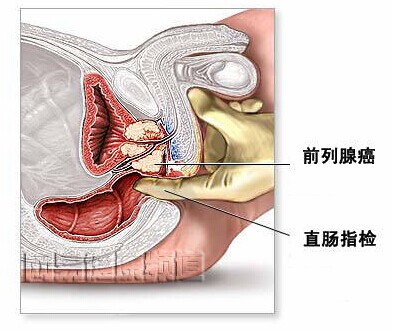 前线腺癌