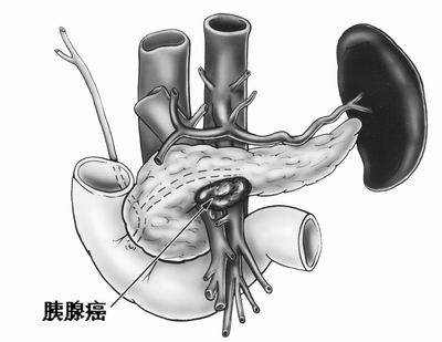 胰腺癌为何云云难治